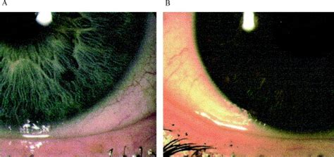 The tear (lacrimal) meniscus height in human eyes: a useful 